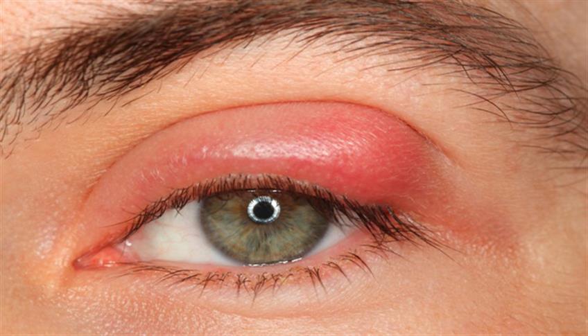 Infiammazione della palpebra, altrimenti detto Orzaiolo Infiammazione della palpebra, altrimenti detto Orzaiolo